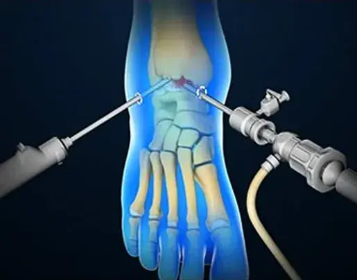 Artroskopiya (Diz, Çanaq, Dirsək, Çiyin-Tac və Topuq)