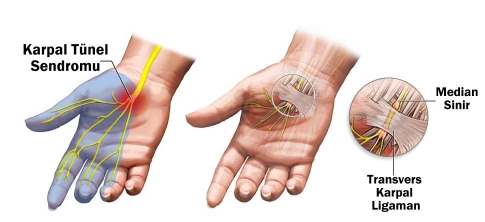 Karpal Tünel Sendromu (KTS)