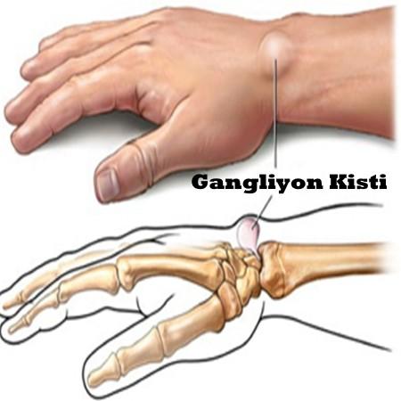 Kistler (Kan Pıhtısı, Higroma)