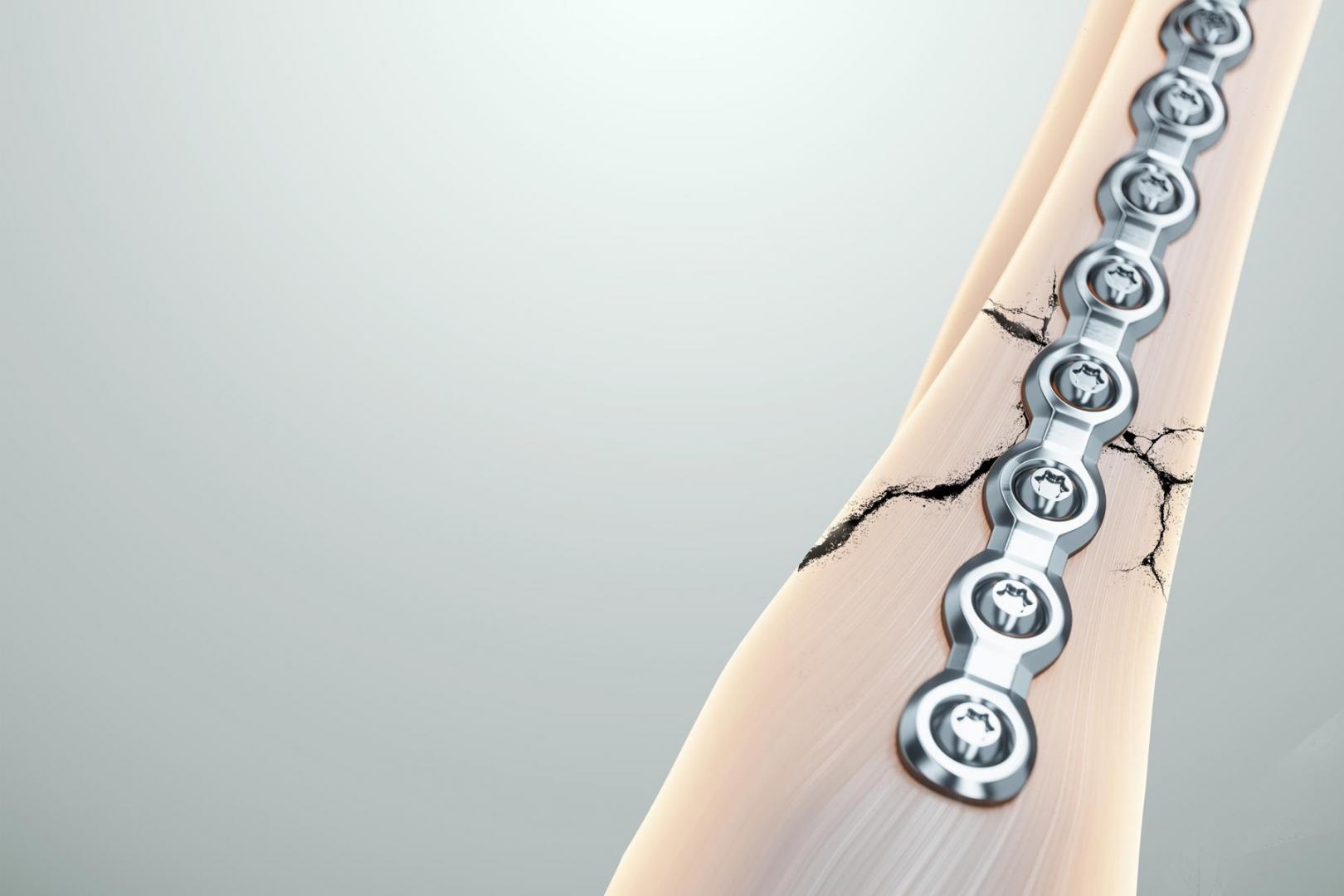 Osteosintez (Açıq və Qapalı)