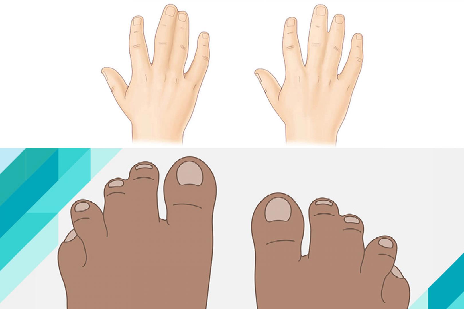 Sindaktiliya və makrodaktiliya