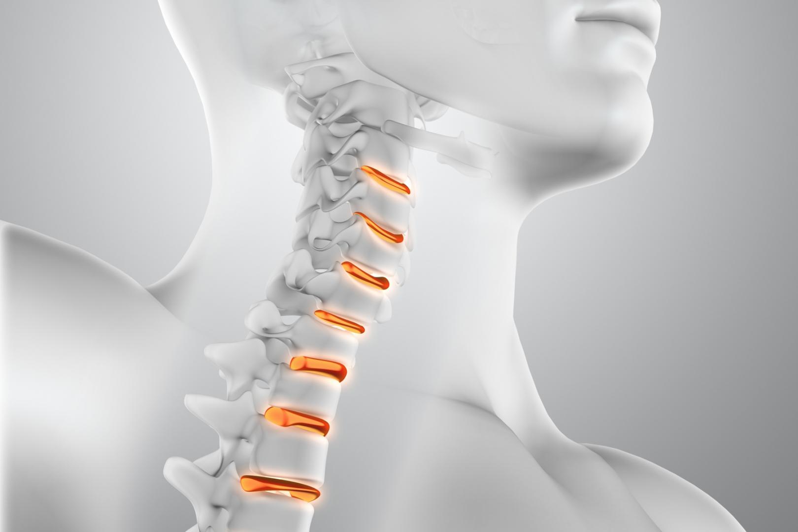 Spina Bifida, Tortikollis (Boyun əyrilikləri)