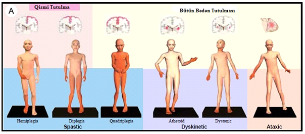 Uşaq serebral iflici